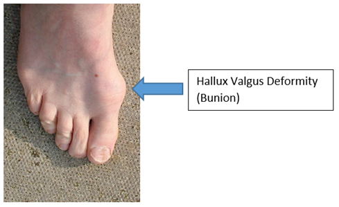 Hallux Valgus Deformity