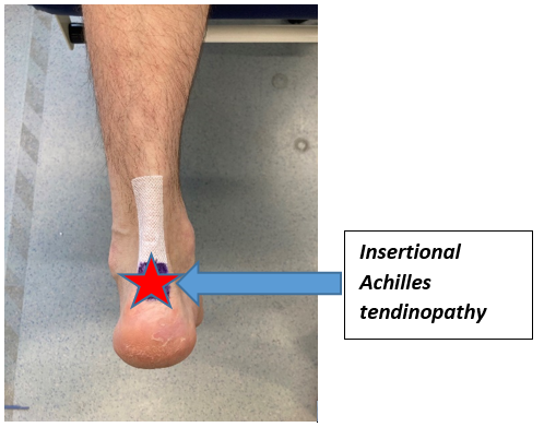 Insertional Achilles Tendinopathy labelled on photo of heel with red star