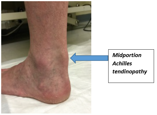 Midportion Achilles Tendinopathy labelled on photo of heel
