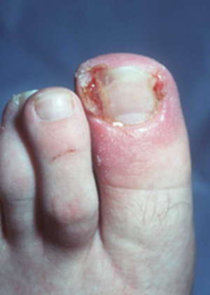 Sore Toe Nail
