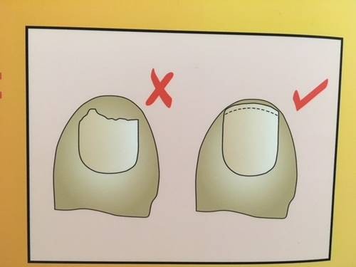 Toe Nails Diagram explaining to cut toenails straight across the curve of the nail