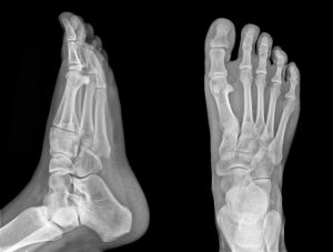 X Rays of feet