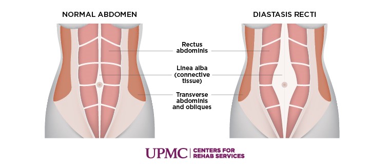 Diastasis Rectus Abdominus (stomach Separation)