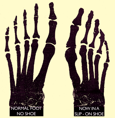 Podiatry Foot Comparison